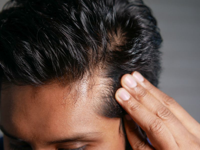 Dandruff-Free Hair for Men